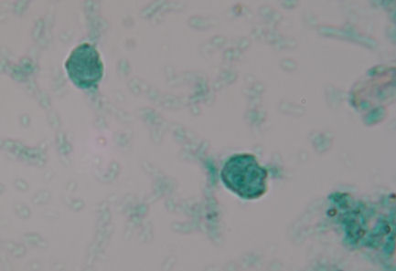 blastocystis